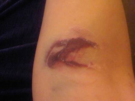 This is the bruise I got after having dye injected for a CT scan to see if my cancer had spread. I cried so hard when I took the bandaid off and saw it. Yuck.