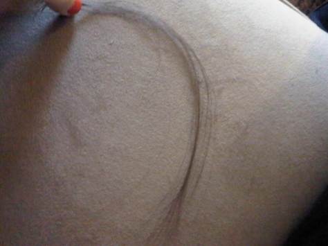 A clump of my hair as it started to fall out.
