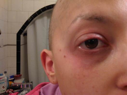 Chemo did all kinds of bad things to me, including causing extreme dry eyes that were constantly painful and looked disgusting. Ew, this pic.