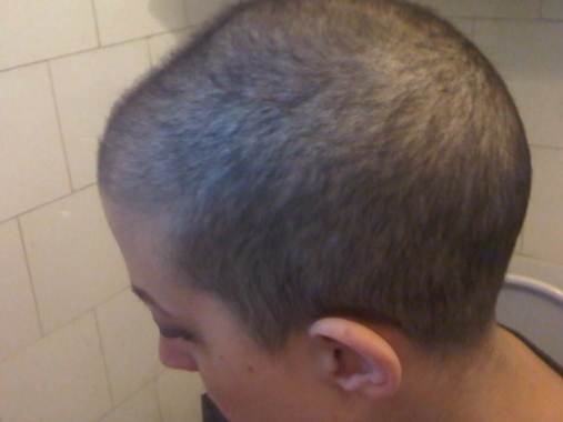 The beginning of the regrowth phase when I became obsessed with taking photos of my scalp to see if I had hair. This photo was taken exactly one year ago.